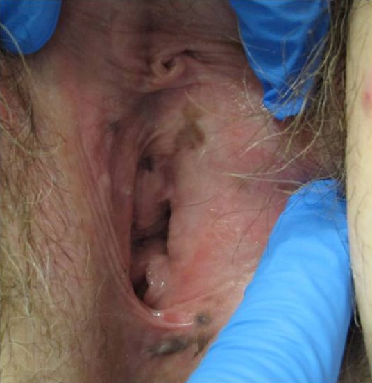 Генитальный меланоз на половых губах