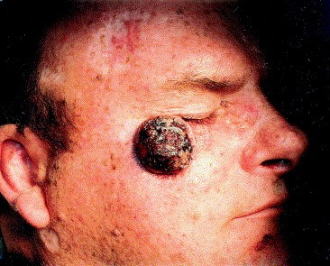 Экзофитная неороговевающая форма плоскоклеточного рака кожи
