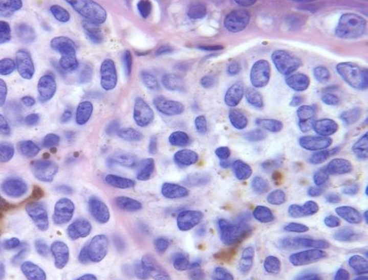Увеличенные в микроскоп клетки невуса.