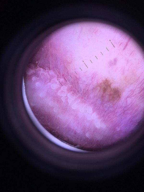 Генитальный меланоз: осмотр с использованием дерматоскопа