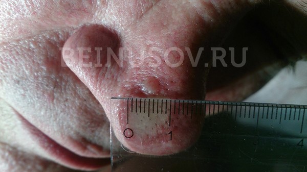 Базалиома кожи носа, узловая форма, размер 5 мм