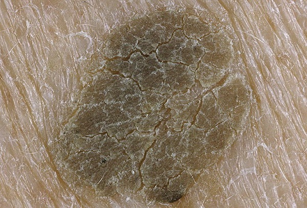На фото – наслоение из ороговевших клеток эпидермиса – симптом себорейного кератоза