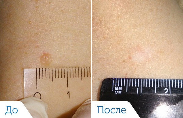 Базальноклеточный рак кожи, поверхностно-распространяющаяся форма: до и после удаления
