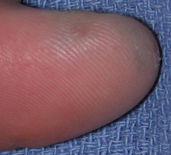 Подногтевая меланома большого пальца c 4-м уровнем инвазии по Кларку, толщина по Бреслоу не указана