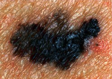 Меланома кожи на ранней стадии