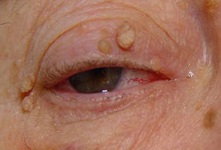 Папилломы зачастую появляются на мягких участках кожи.