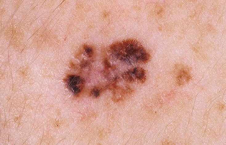 melanoma neskolko tsvetov