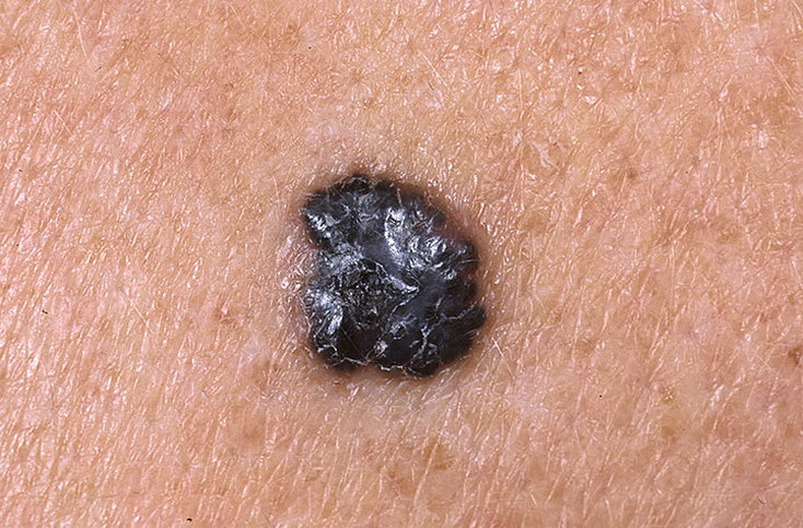 ischeznovenie kozhnogo risunka pri melanome