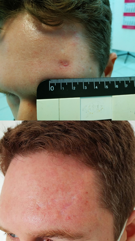 Результат хирургического лечения базалиомы кожи лба