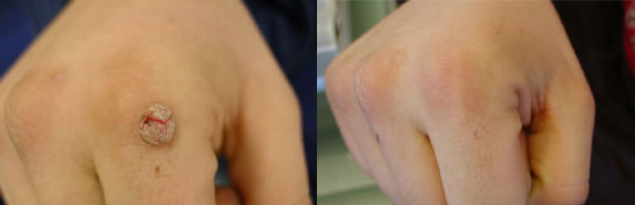 бородавка на руке до и после.jpg