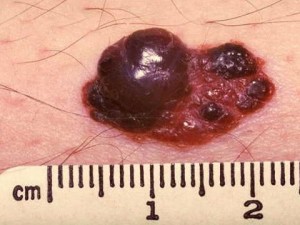 uzelki na poverkhnosti melanomy