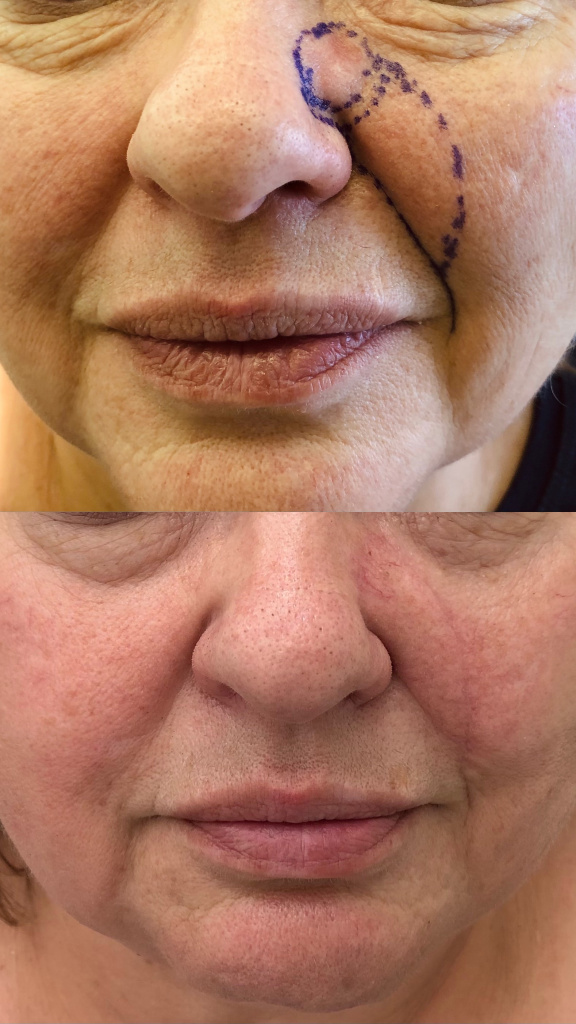 Результат хирургического лечения базалиомы кожи носа