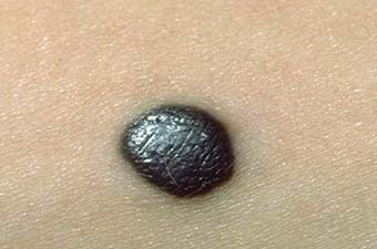 glyantsevaya poverkhnost pri melanome