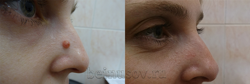 бородавка на носу до и после